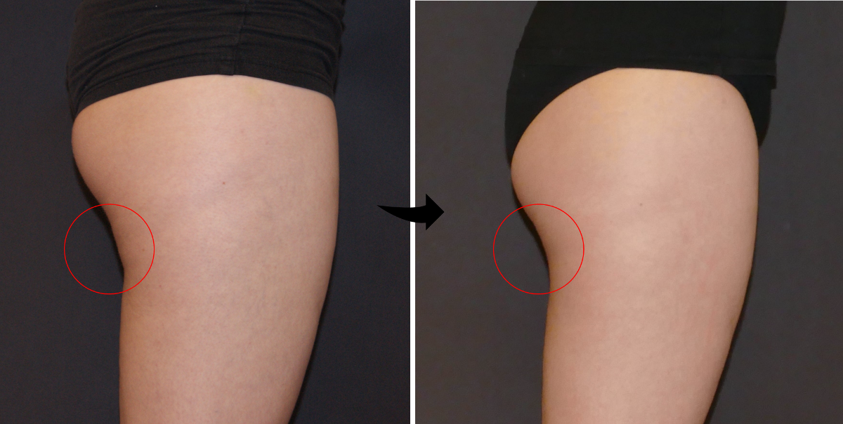 Coolsculpting before and after leg and hamstring